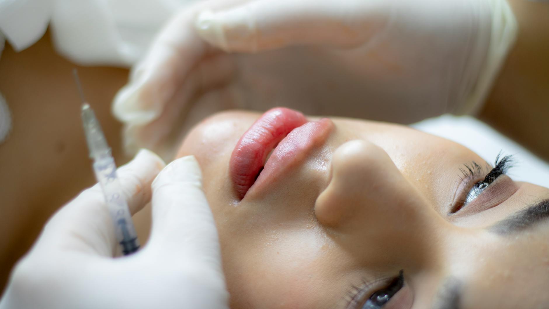 Benefits of Getting Russian Lip Fillers