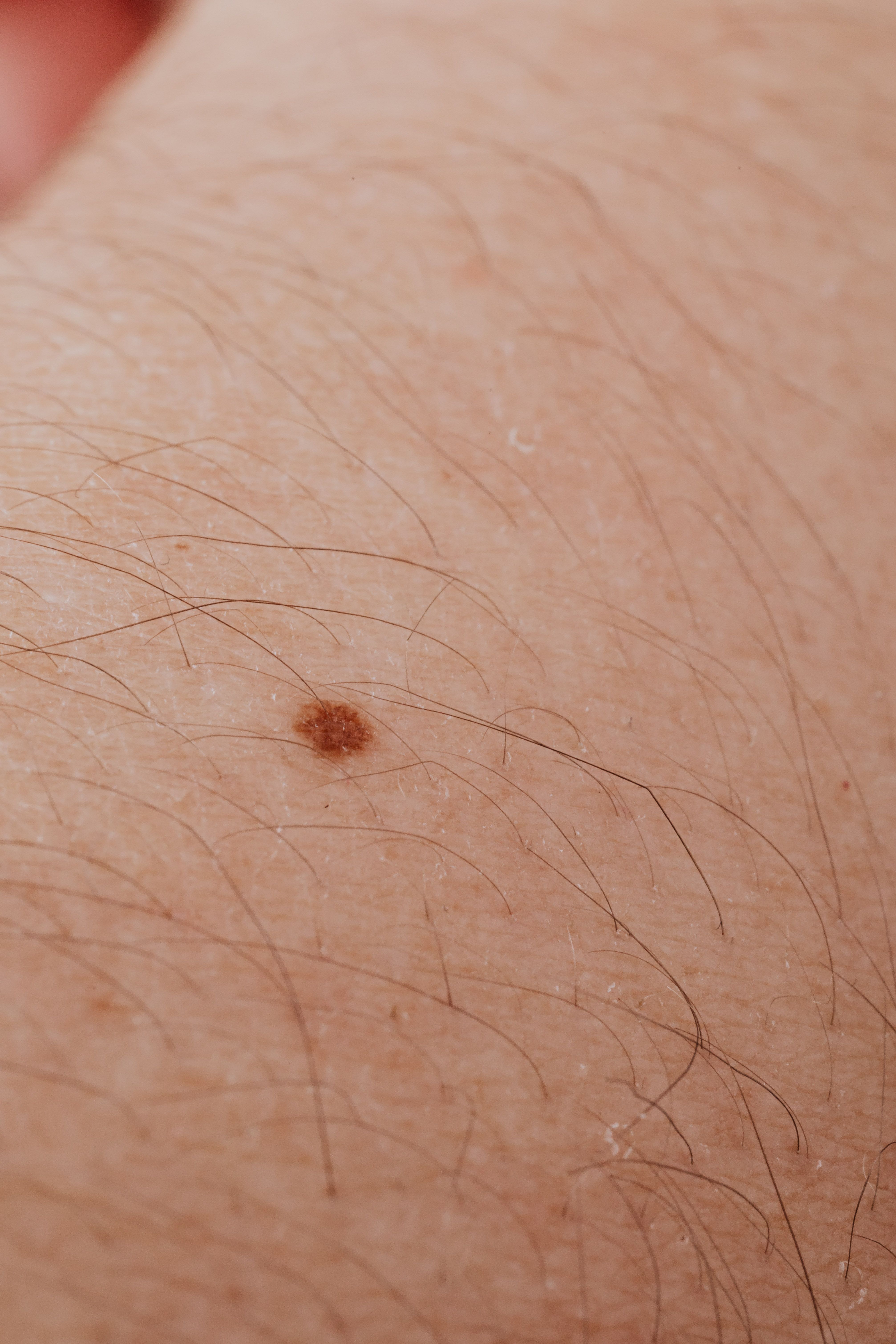 Why Can Nodular Melanoma Be Hard to Recognize in Its Early Stages?