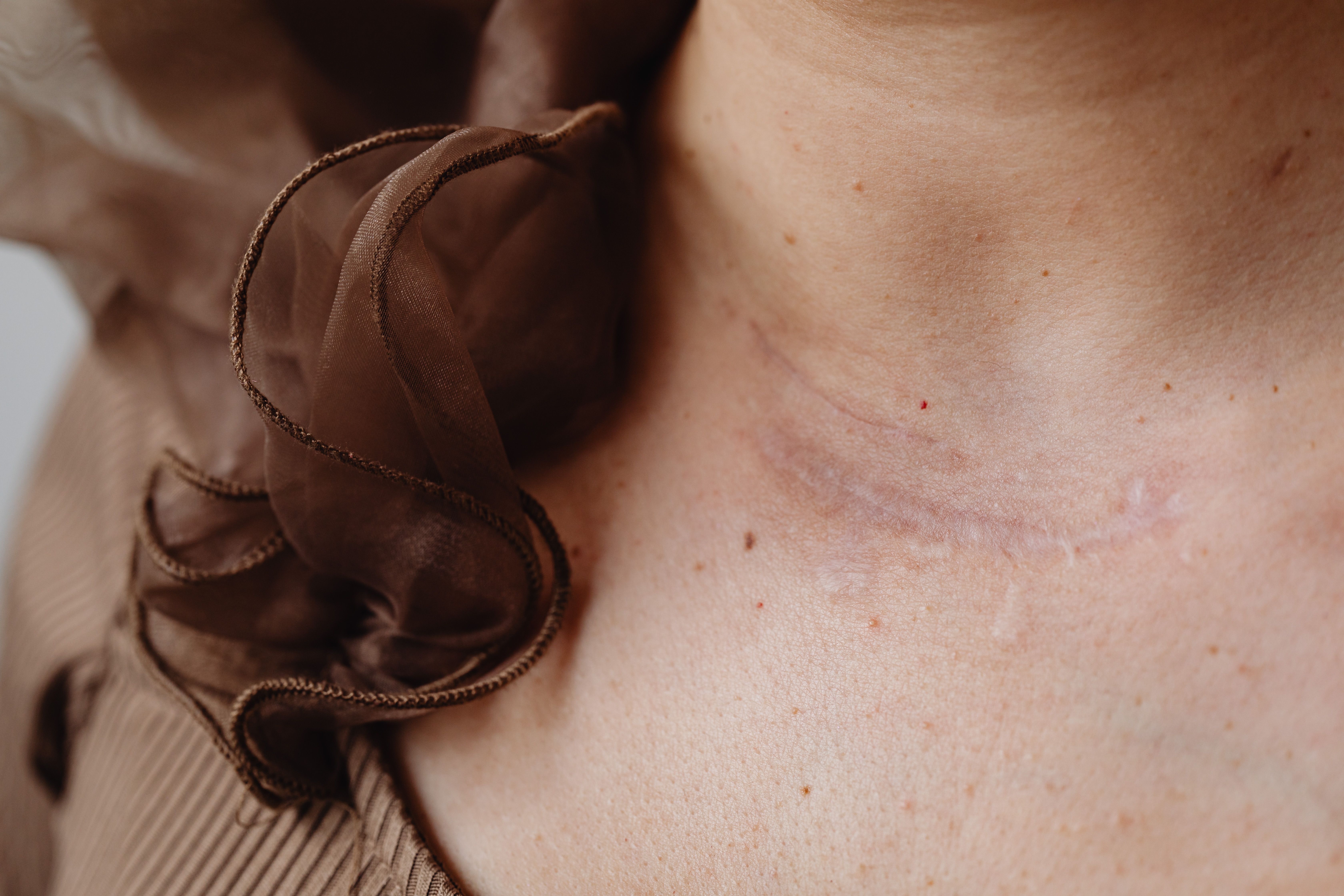 Can Keloids Develop Long After a Skin Injury Has Healed?